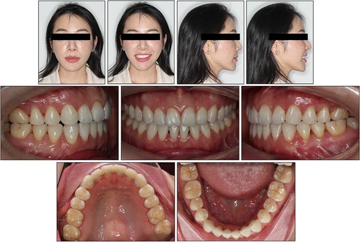 Two-year post-retention facial and intraoral photographs.