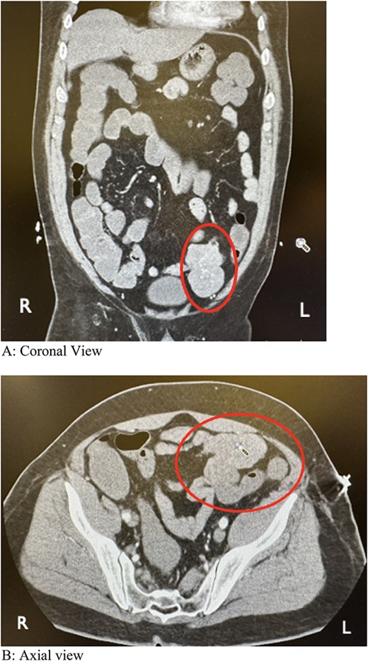 Computed tomography angiography showing a lobulated soft tissue mass associated with distal small bowel loops in the left lower quadrant. (A) Coronal view. (B) Axial view.