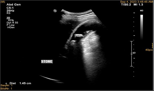 Ultrasonography demonstrated a distended gallbladder, thickened gallbladder wall measuring 6 mm, with multiple gallbladder stones, the largest one measuring approximately 1.4 cm.