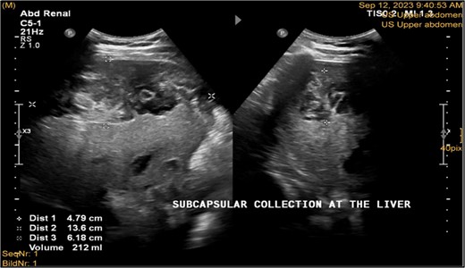 Ultrasonography postlab chole, shows right liver lobe subcapsular heterogenous density collection with liver surface being scalloped and pushed away from the capsule. Volume was about 212 ml. Morison pouch and Lino renal pouch was free.
