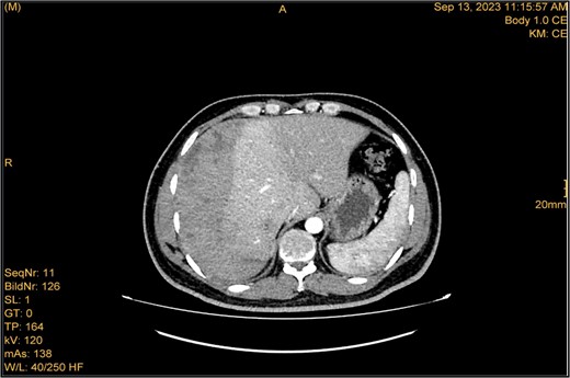 Enhanced CT scan utilizing bleeding protocol. Status post-LC identified significant ISH with internal hyperdensity measuring 7.1 × 19 × 21 cm, in its transverse, anteroposterior, and craniocaudal diameters, respectively. Adjacent hyperemic liver parenchyma with intraparenchymal hematoma noted at segment 5, measured 4.7 × 4 × 4.7 cm. Intraparenchymal hypodensities noted at segments 8 and 4b, likely represent hepatic contusions and lacerations. No evidence of active contrast extravasation.