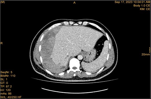 The study was done utilizing monophasic porto venous phase demonstrating intact vasculature. Relatively stable significant subcapsular and intraparenchymal hepatic hematoma with underlying parenchymal contusion and laceration. The study appears unremarkable with no new significant interval change.