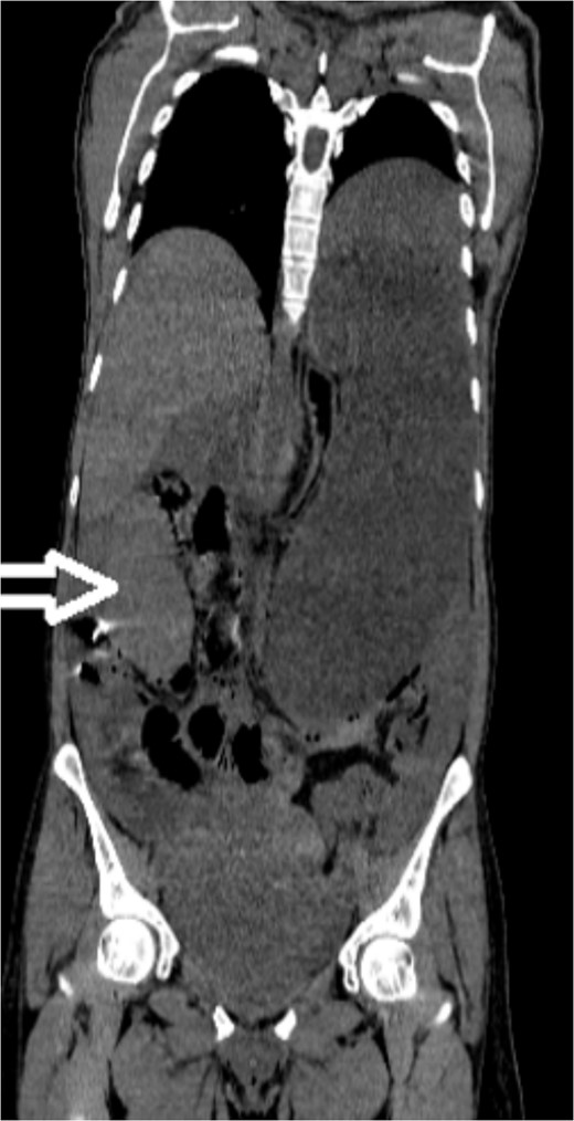 Noncontrast coronal CT scan of the abdominopelvic area showing the spleen located in the right upper abdominal area.