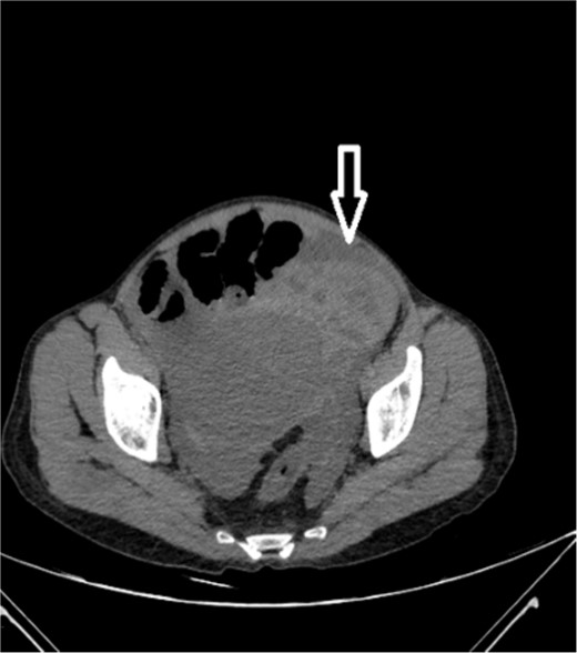 Noncontrast axial CT scan of the abdominopelvic area showing a left-sided pelvic hematoma.