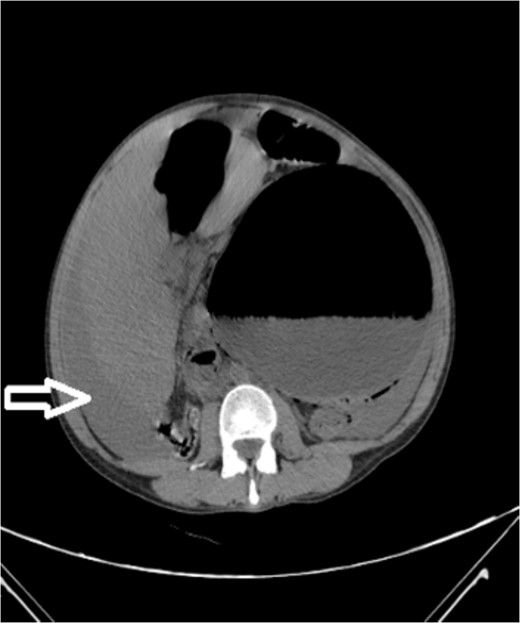 Noncontrast axial CT scan of the abdomen showing a perihepatic hematoma.
