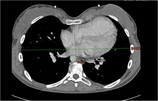 Computed tomography of Patient 1.