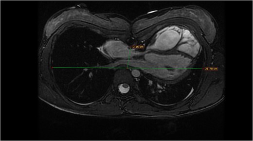 Magnetic resonance tomography of Patient 2.