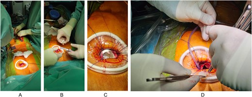 Intraoperative steps of the procedure. A. Establishment of the cardiopulmonary bypass, B. Preparation for bioprosthetic valve implantation, C. Bioprosthetic valve set in place, D. Pulmonary Trunk closure with a bovine pericardial patch tailored and sewn.