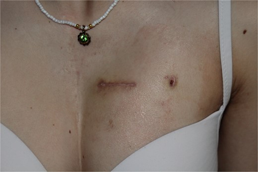 Wound healing 30 days postoperatively.