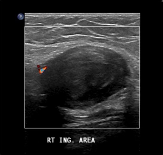 The US image revealed a well-defined hypoechoic heterogeneous echotexture mass lesion seen in the right inguinal area.