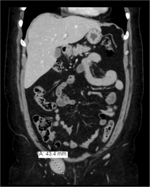 Enhanced (CT) of the abdomen and pelvis was done, and it showed a heterogeneously enhancing well-defined lesion in the right inguinal canal.