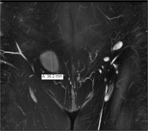 The MRI showed an enhancement and solid lesion in the right inguinal area.