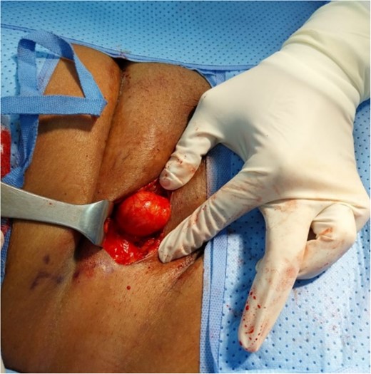 Well-shaped circular lesion found just beneath the Scarpa’s layer.