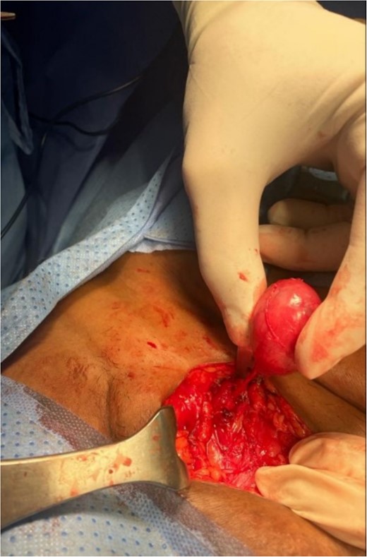 The picture shows the lesion with an attached cord-like structure going deep through the abdominal wall layers, most likely a remnant of the round ligament.