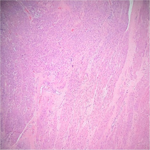 Interlacing bundles of benign smooth muscle cells, separated by collagen bundles.
