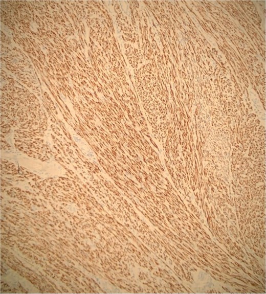 Diffuse positivity for desmin.