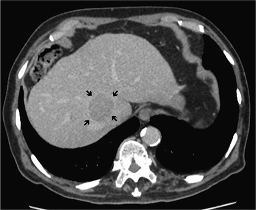 Dynamic computed tomography of the liver. Portal phase of dynamic CT shows a low-density area abutting the RHV, indicating hepatocellular carcinoma located in the caudate lobe (arrows).
