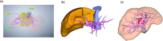 Preoperative radiological assessment of the liver. (a) Three-dimensional reconstruction of preoperative liver anatomy: yellow areas indicate the caudate lobe of the liver (S1) and the pink lesion indicates hepatocellular carcinoma. (b) The glissonian pedicles of the caudate lobe. (c) Portal and hepatic veins are shown as vessels in pink and blue, respectively. The tumor is located in the paracaval portion, adjacent to the right and MHVs.