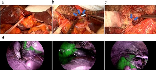 Intraoperative findings during an anatomical complete caudate lobectomy. (a) The left and right glissonian pedicles were secured by a tape. (b) Identification of the Glissonian pedicles of the caudate lobe with a good view after transecting the liver parenchyma, which was achieved using an anterior approach. (c) Ligation of the right-most Glissonian pedicle of the caudate lobe. (d) Definitive delineation of the boundary between the caudate and right lobes by negative counterstaining using indocyanine green fluorescence.