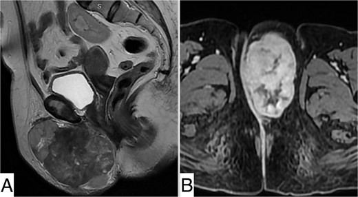 Sagittal (A) and axial (B) MRI images of the vulvar mass.