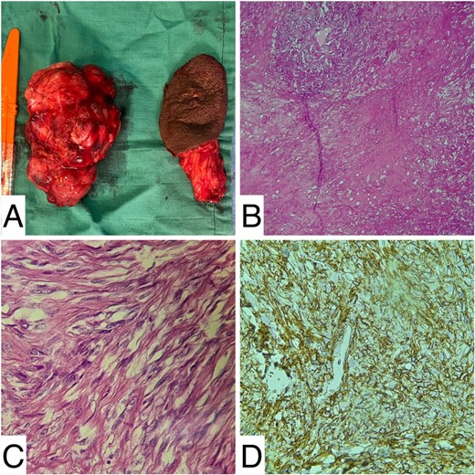 Histology images: (A) gross image of the resected mass; (B and C) medium and high magnification showing fibroblasts and capillary vessels; (D) CD34 positivity at immunochemistry.