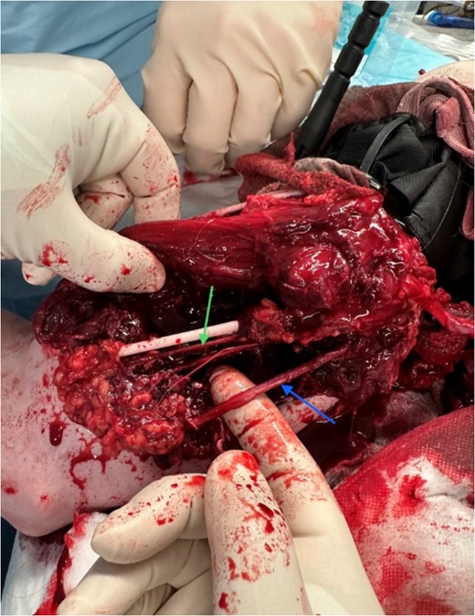 Identification of important structures and damage sustained; torniquet in situ; green arrow: medial brachial cutaneous nerve; blue arrow: ulnar nerve.