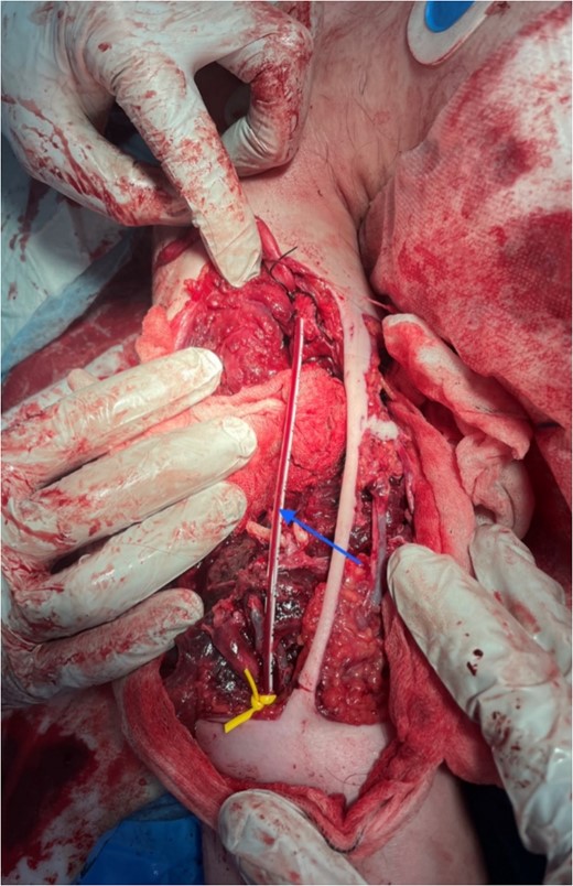 Insertion of paediatric feeding tube as TIVS w/ reperfusion; blue arrow: paediatric feeding tube tied to ends of transected brachial artery.