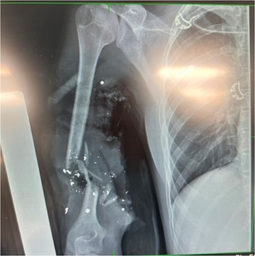 X-ray showing extent of damage to humerus; bullet shrapnel visible.