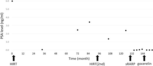 The patient’s serum prostate-specific antigen (PSA) level before heavy-ion therapy (HIRT). His PSA level before the HIRT was 5.99 ng/ml. Biochemical progression was observed after two sessions of the HIRT. His PSA level decreased below detection sensitivity after salvage robotic-assisted radical prostatectomy.