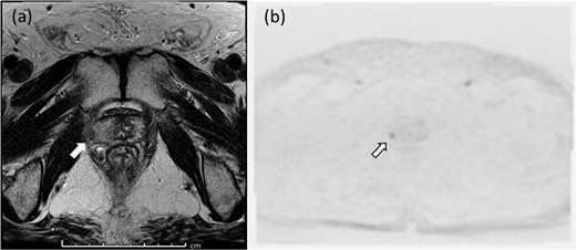 Pelvic magnetic resonance imaging revealed a lesion in the right peripheral zone of the prostate (a, b).