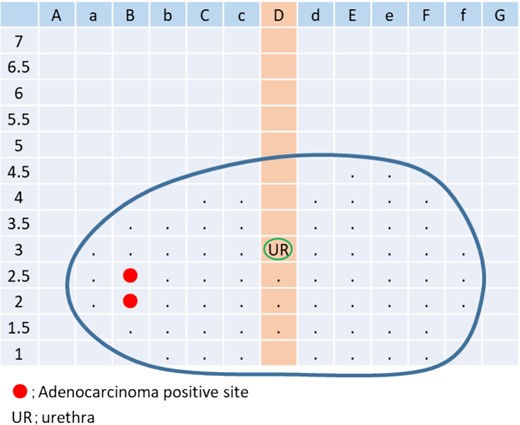 Positive site of template needle biopsies.