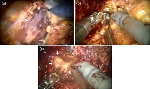 Operative findings after salvage robotic-assisted radical prostatectomy. The left endopelvic fascia had a strong adhesion to the levator ani and was challenging to divide (a). The retrotrigonal layer forming the left side had an extremely strong adhesion and could not be identified (b). The back part of the prostate had the strongest adhesions. The left ampulla of the vas deferens was almost dissolved and could not be identified (c).