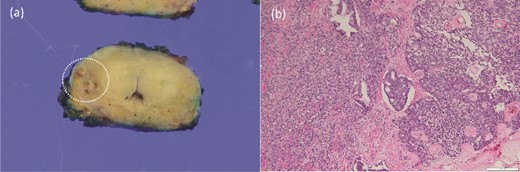 Macroscopically, infiltrating tumor cells with a maximum diameter of 13 mm were observed in the right peripheral zone (a). Histopathological examination showing invasive prostatic adenocarcinoma and hematoxylin and eosin staining at a magnification of ×100 showing perineural invasion and lymph node invasion (b).