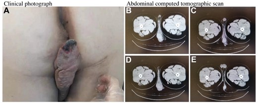 The soft mass and computed tomographic scan of the pelvis.