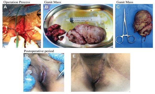 The operation process was to remove the tumor by electric knife.