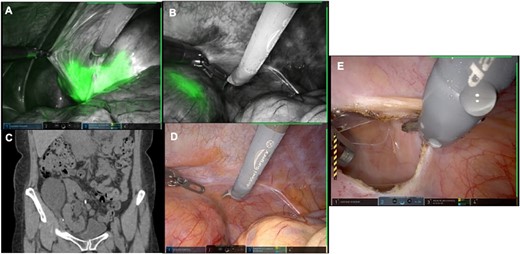 (A) Robotic Firefly visual display of the transplanted kidney inferior pole demonstrating ICG within the collecting system. (B) Robotic Firefly display of the transplant kidney superior pole demonstrating ICG within the parenchyma medial to the lymphocele. (C) CT scan with lateral position of lymphocele. (D) Conventional robotic display without ICG. (E) Completed peritoneal window with successful drainage of lymphocele.