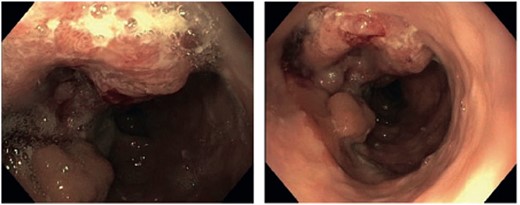 Endoscopic view showing a tumor of the transposed colon 23 cm from the incisors.
