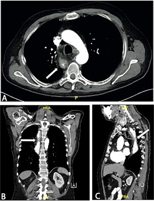 Axial (A), coronal (B), and sagittal slice (C) of a preoperative CT scan showing wall thickening of the neoesophagus proximal to the tracheal bifurcation.