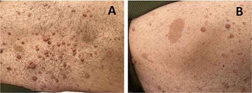 (A) shows multiple neurofibromas, which are benign nerve sheath tumors. (B) depicts café-au-lait spots observed on the patient’s skin.