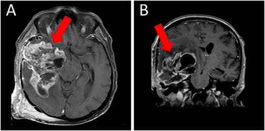 Preoperative T1WI (A) axial and (B) sagittal MRI images of a huge right temporo-parietal intra-axial lesion (indicated by arrows), which show enhancement after gadolinium injection. The axial image also shows extracranial subgaleal plexiform neurofibroma. MRI = magnetic resonance imaging, T1WI = T1-weighted images