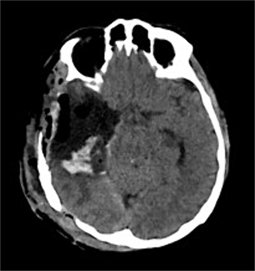 Postoperative axial CT shows postoperative changes with maximum safe resection of the lesion. CT = computed tomography.
