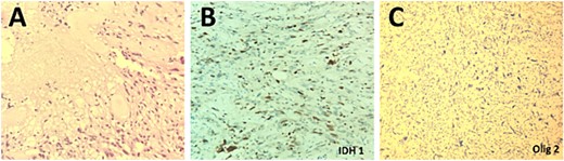 Histopathological examination of the excised lesion demonstrates characteristic features of a Glioblastoma. (A) The section shows high grade glioma with areas of necrosis and vascular proliferative changes (H&E, original magnification ×20). The neoplastic cells are negative for IDH1 immunostain (×20) (B), and positive for Olig2 immunostain (×20) (C).