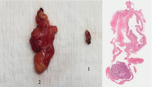 The two masses after surgical excision, along with microscopic slide.