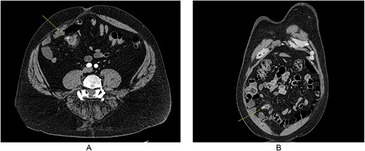 CT imaging showing foreign body in MD, with some inflammation and fat stranding around it. (A) Coronal imaging and (B) cross-sectional.