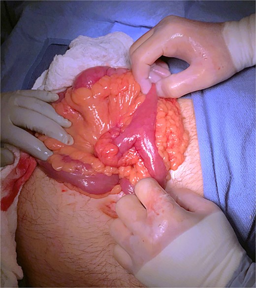 Intraoperative image of MD.