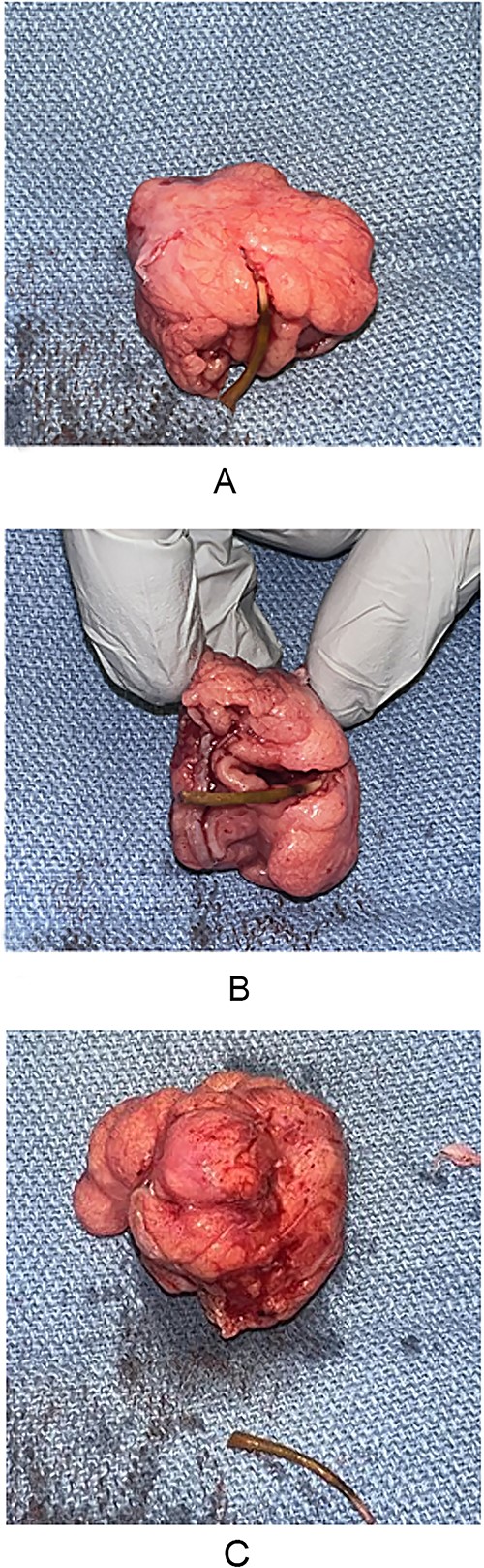 (A–C) MD specimen with foreign body.