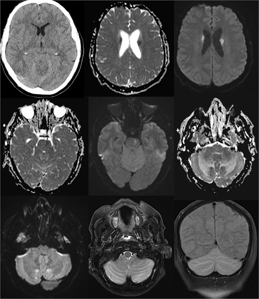 Comprehensive computer tomographic (CT) and magnetic resonance imaging (MRI) of pseudohypoxia brain damage due to CSF loss; from left to right, top to bottom: (1) CT axial view showing general brain structure and pathology; (2 + 3) diffusion-weighted imaging (DWI) and apparent diffusion coefficient (ADC) maps of the basal ganglia, and (4 + 5) DWI and ADC images of the pons; (6 + 7) DWI and ADC images of the cerebellum; (8) T2 Turbo Spin Echo with fat saturation (TSE FS) axial view of the cerebellum; (9) Sagittal T2 turbo inversion recovery magnitude coronal view depicting tonsillar descent with cerebellar edema, and these images illustrate the intricate brain changes associated with pseudohypoxia damage following CSF leakage.