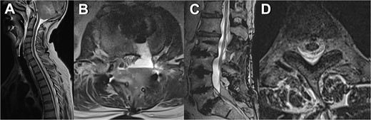 MRI scans depicting various manifestations of liquor leakage; (A) TSE sagittal view of the cervical spine, illustrating fluid distribution and spinal alignment; (B) axial view at the level of the third thoracic vertebra (T3), showing detailed cross-sectional anatomy, and (C) T2-weighted sagittal view, highlighting the spinal cord and surrounding structures; (D) axial view at the level of the second and third lumbar vertebrae (L2/3), providing insights into lower spinal segments.