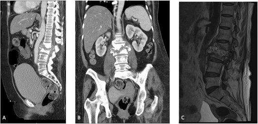 (A) Sagittal section of a CT scan depicting L2–L3 discitis-osteomyelitis. (B) Coronal section of a CT scan depicting L2–L3 discitis-osteomyelitis. (C) Sagittal MRI of the lumbar spine demonstrating severe L2–L3 discitis and L2–L3 osteomyelitis with a large anterior epidural abscess causing severe spinal stenosis at the L2 and L3 levels.