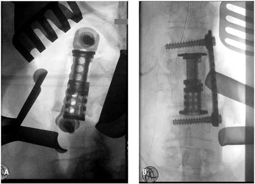 (A) Anterior intraoperative fluoroscopy demonstrating final titanium cage placement spanning from L1 to L4. (B) Lateral intraoperative fluoroscopy demonstrating final titanium cage placement spanning from L1 to L4.